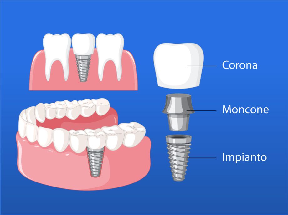 Endrio Tisano Immediate load implantology - dentist